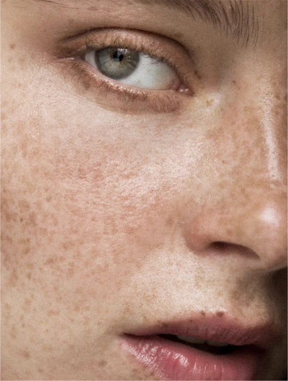 Close-up of a person's eye with visible freckles on their skin.