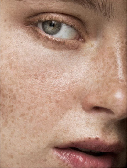 Close-up of a person's eye with visible freckles on their skin.